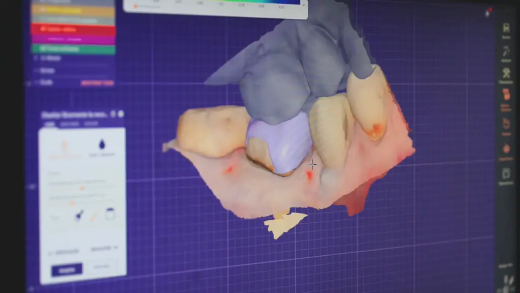 Reconstrucción digital en 3D de una dentadura con el scanner intraoral de CPH Salud