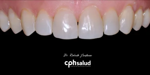 Primer plano de dientes anteriores rehabilitados con carillas dentales en CPH Salud